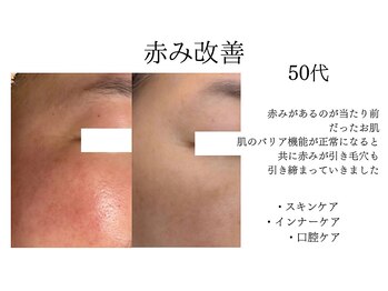 シャルナ(charna)/赤み症例 オンライン肌改善