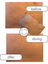 お肌の土台から整える　sol y luna　麻布十番店【肌質改善/エイジングケア】/緩んだ毛穴もゾンビマスク