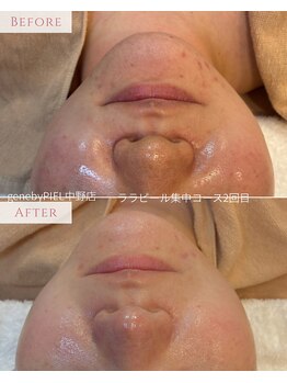 ジーンバイピエル 中野店(gene by PIEL)の写真/【当店人気No.1新ララピール】毛穴も肌質も変わる！結果重視の施術でお肌悩みを解決に導きます。【中野】
