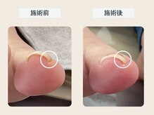 ルポ 伊勢/巻き爪ケア