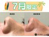 【7月限定】いちご鼻解消♪毛穴洗浄(鼻のみ)+保湿仕上げ¥3500