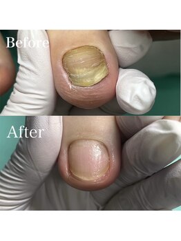 巻き爪補正店 千葉店の写真/爪を隠す生活とはおさらば！指先に彩りを添えて本来の自身を取り戻せる素敵なフットケアサロンへ☆