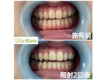 ルブラン 奈良店(Le Blanc)/当店のホワイトニング効果