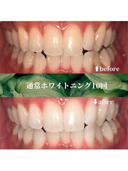 フタバ 天神大名店(futaba)/セルフホワイトニング10回