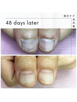 ユユネイル(yuyu nail)/深爪育成コース
