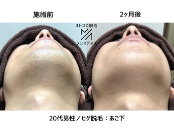 サロンアメリ イオンモール綾川店(Salon Ameri)/香川　メンズ脱毛　ヒゲ脱毛