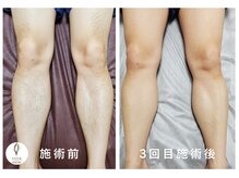 ヴォアール 名古屋店(VOIR)/メンズ脱毛　脚脱毛
