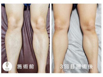 ヴォアール 名古屋店(VOIR)/メンズ脱毛　脚脱毛