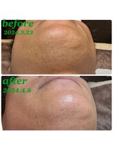 アンレーヴ 津幡店/ひげ脱毛1ヶ月経過