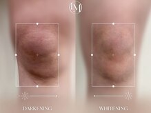 天然成分使用/着色料不使用/痛みほぼゼロ/1回の施術で半永久持続