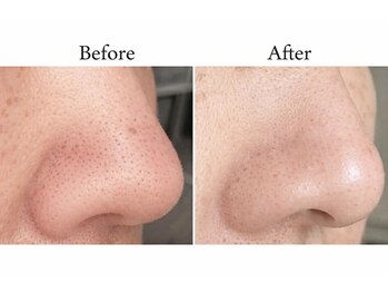 ベラピエル(BELLA Piel)/ビフォーアフター