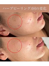 リボンサロン(Ri.bon Salon)/ハーブピーリング/黒ずみ撃退