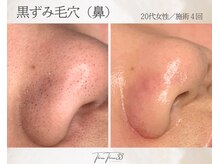 スリースリー 恵比寿(THREE THREE)/毛穴角栓・毛穴黒ずみ・毛穴開き