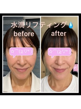 ココスタイルビューティー(COCOSTYLE beauty)の写真/ララピール 、水光ピール、臍帯間葉系幹細胞、幹細胞、エクソソーム、ソマチッド