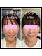 ココスタイルビューティー(COCOSTYLE beauty)の写真/ララピール 、水光ピール、臍帯間葉系幹細胞、幹細胞、エクソソーム、ソマチッド