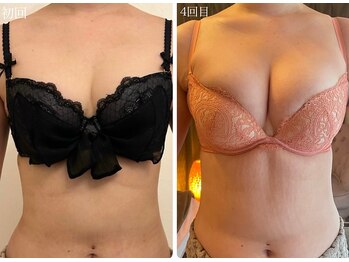 美人バスト 岡崎店/【バストアップ★育乳】症例