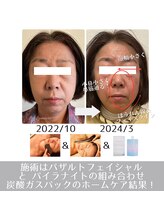 ラ ルミエール(La Lumiere)/継続することで、小鼻に変化！