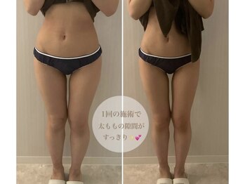 ミセル(MISEL2nd)/キープ力◎リピートNo.1最新痩身