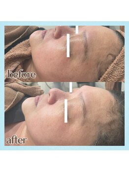 レヴール(reveur)/ハーブピーリングで美肌ケア