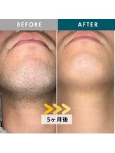 モモナ(Momona)/佐世保/脱毛/髭脱毛/全身脱毛