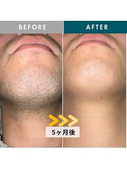 モモナ(Momona)/佐世保/脱毛/髭脱毛/全身脱毛