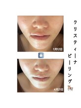 アイリス(AIRIS)/フェイシャル/毛穴洗浄/美白