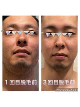 サロン ド リア(salon de Lia)/メンズヒゲ脱毛