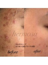 リュクス &nbsp;Luxe＋tkm 南船場/ハーブピーリング