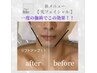 【光フェイシャル】たるみ改善☆通常¥8,000→初回特別価格¥3,000