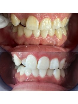 エクシアホワイトニング 新小岩店/ホワイトニングビフォーアフター