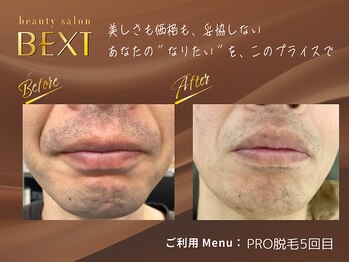 ベクスト(BEXT)/ヒゲ脱毛(PRO)