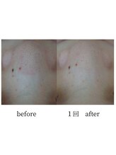 アップルミント/＜フェイシャル＞before・after