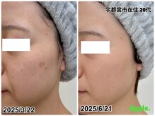 アップル 宇都宮店(Apple.)/肌質改善プログラム