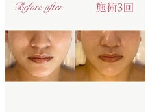 パルタージュ 三宮(Partage)/剥離なし！プレハーブピーリング