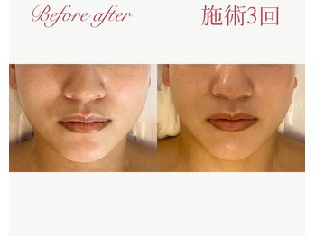 パルタージュ 三宮(Partage)/剥離なし！プレハーブピーリング