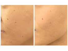 イーオ(io)/デコボコ毛穴が…