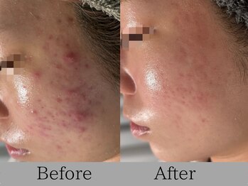 ルミライズ(lumirise)/〈9回目での効果〉