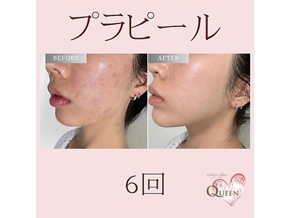 クイーン(QUEEN)の写真