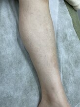 ナノハナ/鹿沼市の全身脱毛のナノハナ