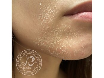 ハーバリー ハーブピーリング 岐阜(HERBERRYハーブピーリング)/ハーブピーリング専門店HERBERRY