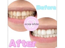 エクシアホワイト 浦安店/ホワイトニングビフォーアフター