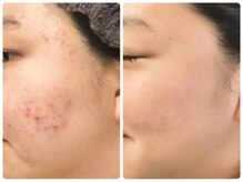 ラウン 京都(ROUN')/約1年の施術ビフォーアフター