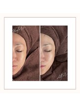 カラット(CARAT)/光フェイシャル