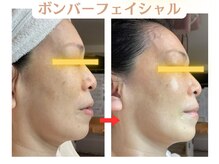コトハ(cottha)/1回施術後