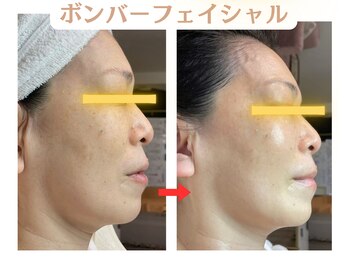 コトハ(cottha)/1回施術後
