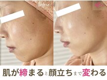 ソワンドビジュー(soin de bijew)/剥けないハーブピーリング