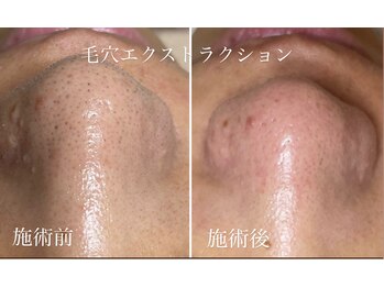 テテメルティ(te-te melty)/毛穴エクストラクション