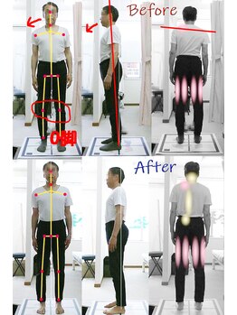 姫路なごみ整体院 なごみ鍼灸院/改善例（左下肢痛・膝痛・O脚）