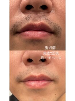 ムッシュ カナザワ(KANAZAWA)/脱青ヒゲ