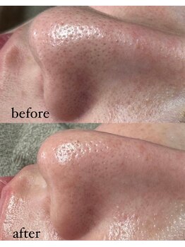 ラニー アンド ココネイル(LANIE&CocoNail)/長年のお鼻のポツポツ悩みに！